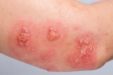 Pemfigoide bolloso: sintomi, cause e trattamento