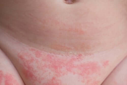 Pube con dermatite e corticosteroidi.