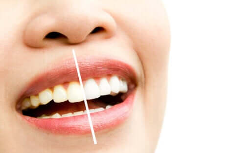 Ragazza con denti macchiati.
