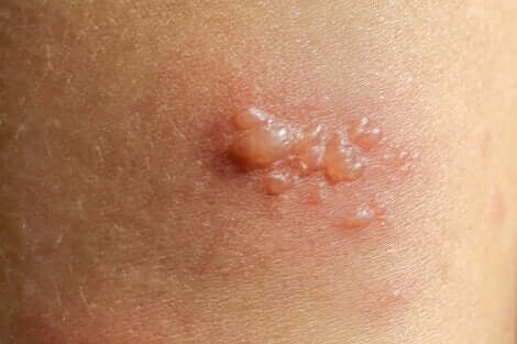 Uno dei segni del pemfigoide bolloso è la presenza di vesciche sulla pelle.