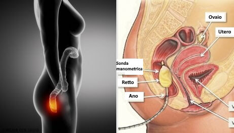 Proctite e anatomia di intestino e utero.