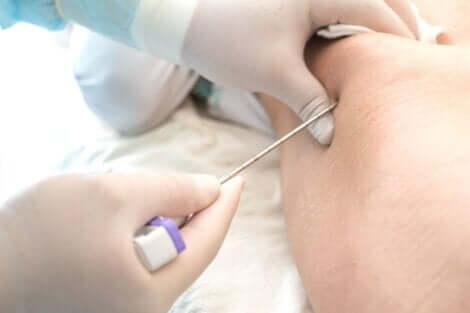 Biopsia del midollo osseo.