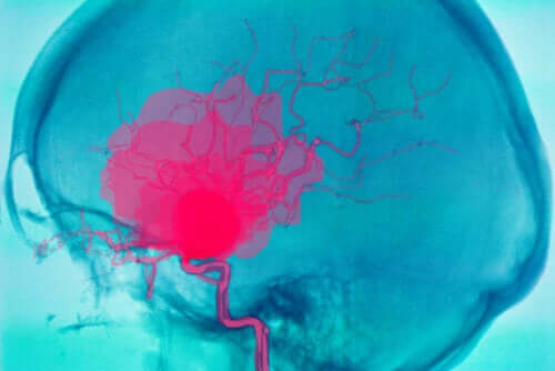 La emorragia cerebrale: cos'è e perché può verificarsi?