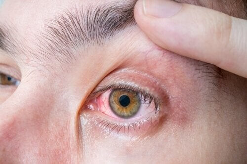 Melanoma oculare: sintomi e cause
