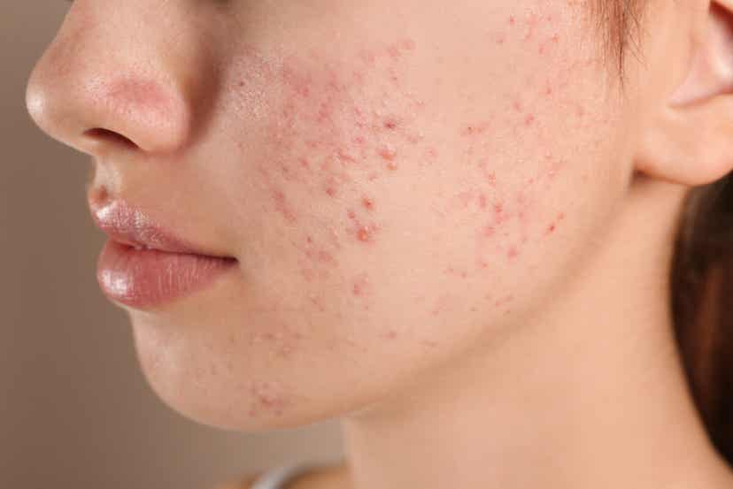 Usare l'olio di moringa contro gli inestetismi dell'acne.