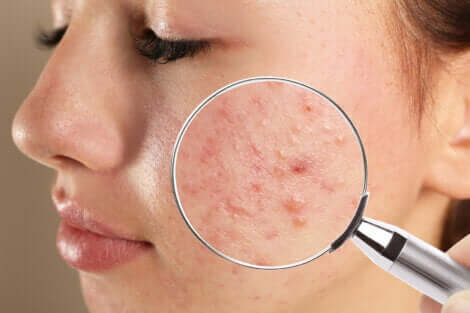Lente d'ingrandimento volto acne.