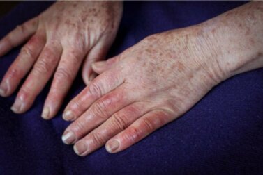 Malattia di Buerger: cause, sintomi e trattamenti