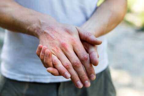 Uomo con dermatite alle mani.
