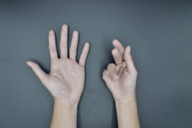 Morbo di Dupuytren: cause, sintomi e trattamenti