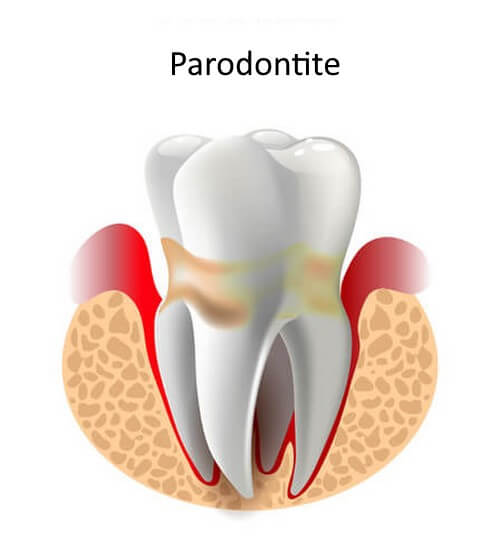 Parodontite con dente infiammato.