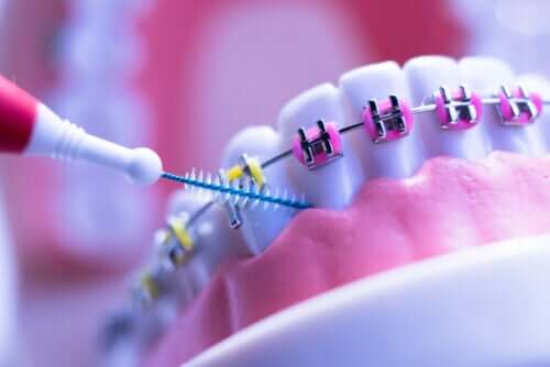 Apparecchio ortodontico: 8 precauzioni