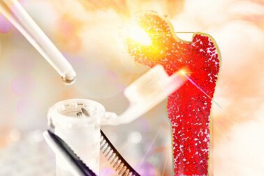 Aplasia midollare: tutto quello che c'è da sapere