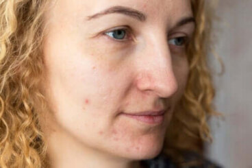 Prevenire il melasma: alcuni consigli