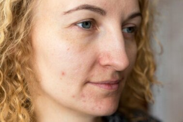 Prevenire il melasma: alcuni consigli