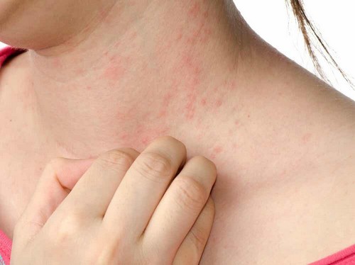 Eczema e stress.