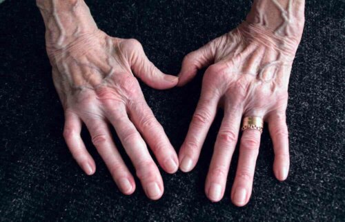 Mani con artrite reumatoide.