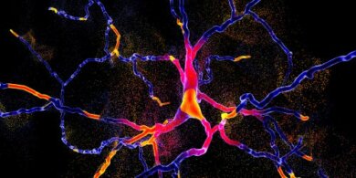 Differenziare Parkinson e atrofia sistemica multipla