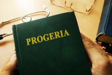 Sindrome di Werner: invecchiare troppo in fretta