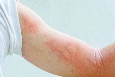 Eczema e stress: quale correlazione?