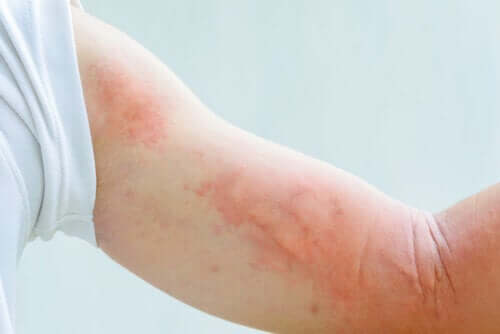 Eczema e stress: quale correlazione?