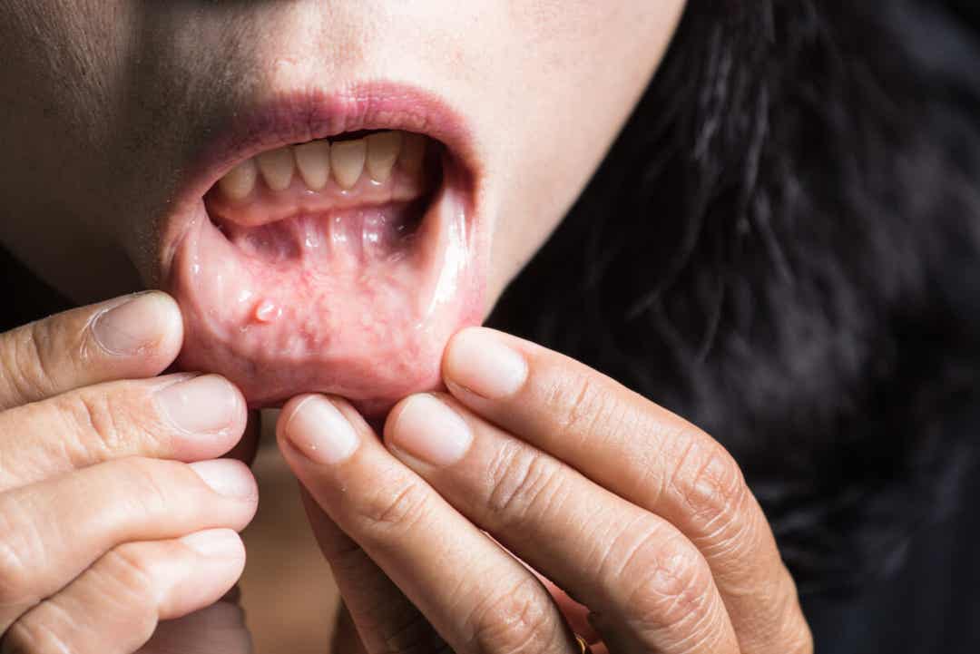 Ragazza con sarcoma di kaposi.