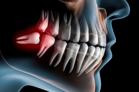 Denti impattati: cosa sono e come si curano?
