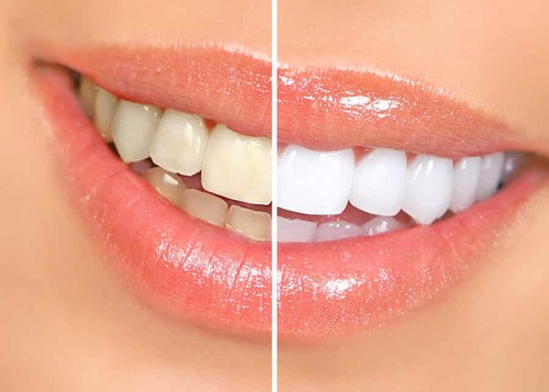 Denti prima e dopo lo sbiancamento.