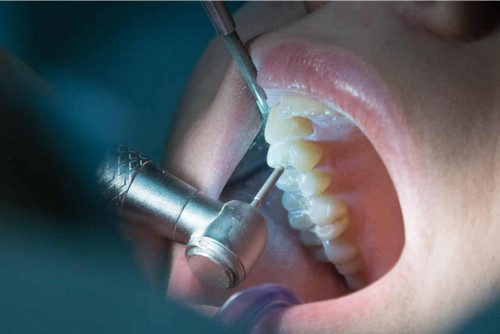Trattamento endodontico.