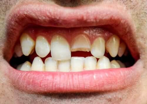 Trauma dentale: definizione e diversi tipi