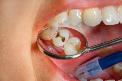 Carie nei denti.