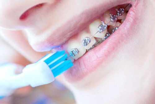 Rivelatori di placca: igiene orale con apparecchio ortodontico.