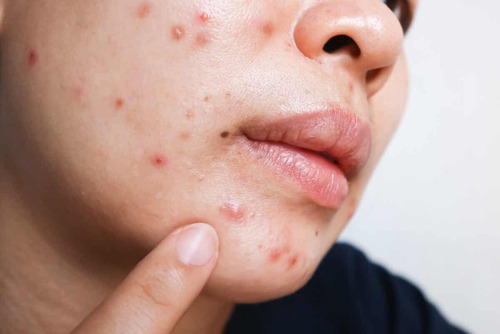 Acne sul viso.