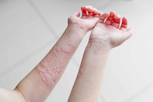 Orticaria sulle braccia