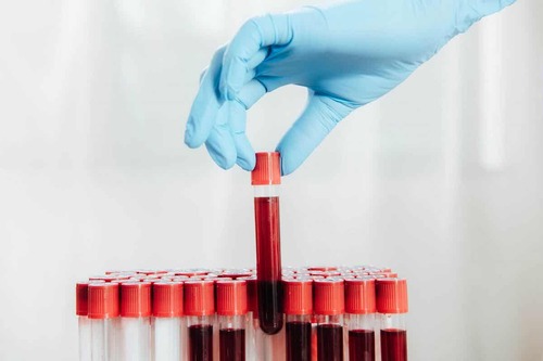 Esame del sangue come test rapido per la miocardite.