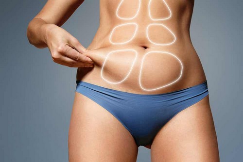 La diastasi addominale.