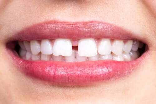 Diastema dentale: di cosa si tratta?