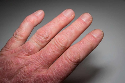 Fenomeno di Raynaud nel lupus.