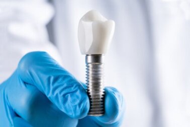 Perimplantite: cause, sintomi e prevenzione