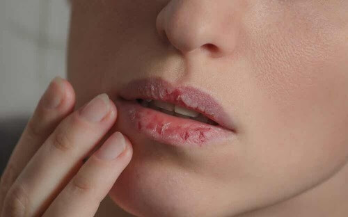 Cambiamento nel colore delle labbra: labbra screpolate.