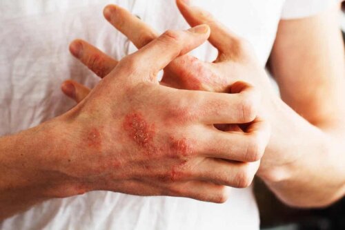 Psoriasi alle mani.