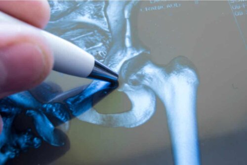 Radiografia dell'anca.