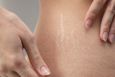 6 ricette fai da te e naturali per trattare le smagliature