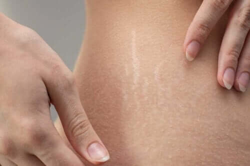 6 ricette fai da te e naturali per trattare le smagliature