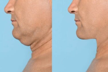 5 esercizi per tonificare e definire la mascella