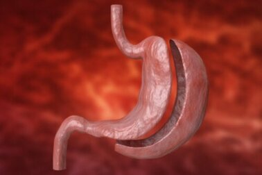 Sleeve gastrectomy per il trattamento dell'obesità: in cosa consiste?