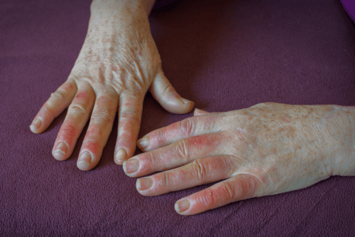 Fenomeno di Raynaud: sintomi, diagnosi e trattamento
