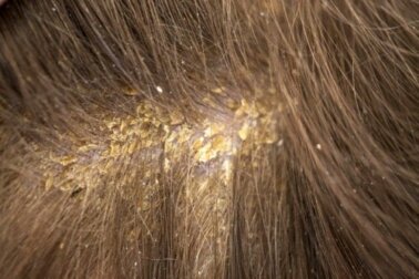 Croste sul cuoio capelluto: 13 possibili cause