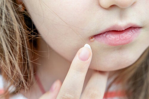 Come distinguere un brufolo da un herpes labiale?