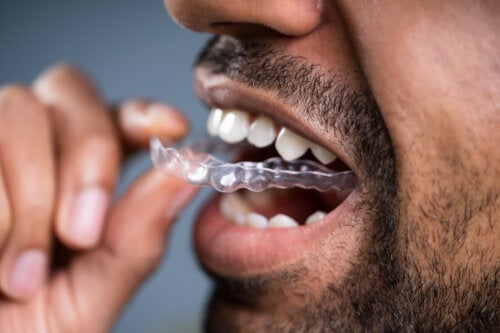 13 dubbi che devi risolvere prima di scegliere l'ortodonzia invisibile