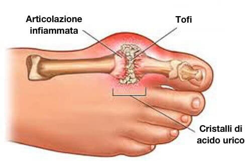 Infiammazione articolare nel piede